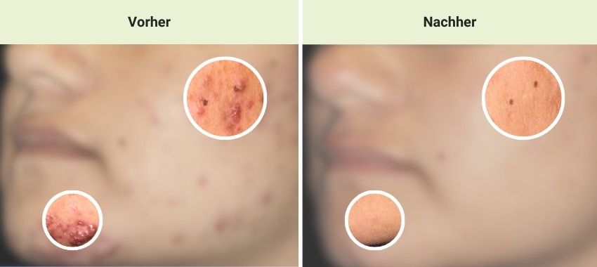Akne Laserbehandlung mit AviClear® in der Sophienklinik Stuttgart Akne Laserbehandlung mit AviClear ® – Vorher und nachher