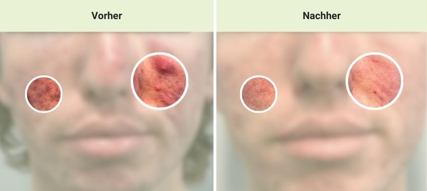 Akne Laserbehandlung mit AviClear® in der Sophienklinik Stuttgart Akne Laserbehandlung mit AviClear ® – Vorher und nachher