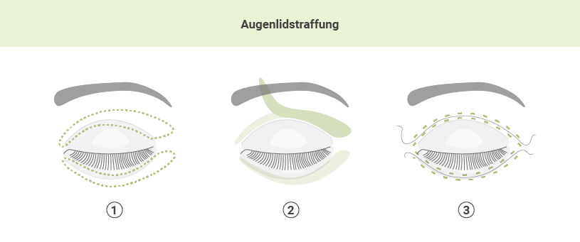 Augenlidstraffung in der Sophienklinik Stuttgart