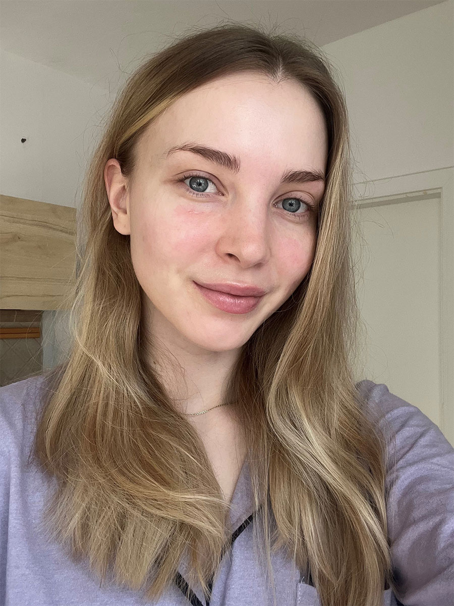 Zuzanna ohne Make-up nach der Aviclear-Behandlung