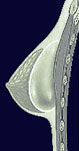 Implantat über dem Muskel