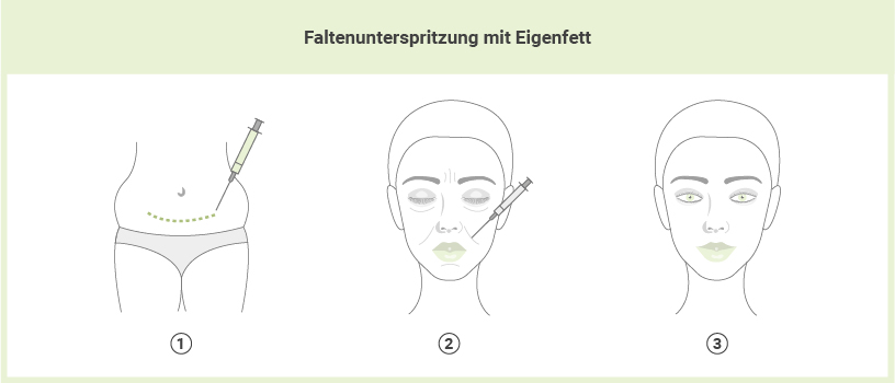 Faltenunterspritzung mit Eigenfett Faltenunterspritzung mit Eigenfett