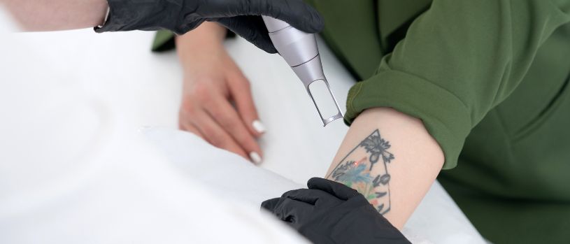 Tattooentfernung Tattooentfernung in der Sophienklinik Stuttgart