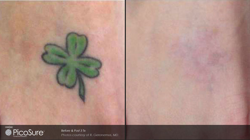 Tattooentfernung in der Sophienklinik Stuttgart Vorher-Nachher