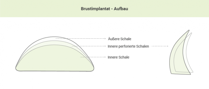 Brustimplantat Aufbau 
