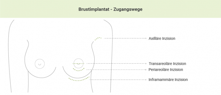 Brustimplantat Zugangswege